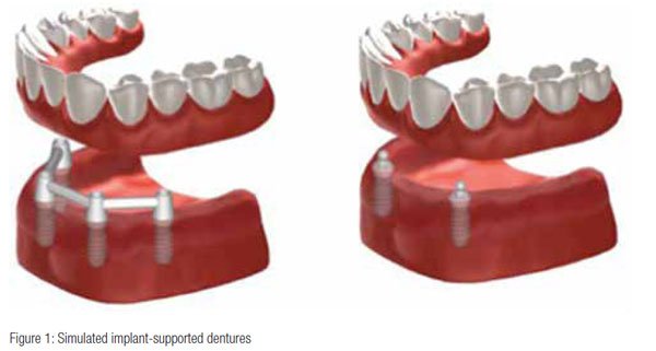 overdenture